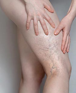 Spider Veins (Sclerotherapy) in Schaumburg, IL and Chicago, IL Spider Veins (Sclerotherapy) in Schaumburg, IL and Chicago, IL