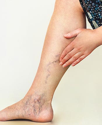 Varicose Veins (Phlebotomy) in Schaumburg, IL and Chicago, IL Varicose Veins (Phlebotomy) in Schaumburg, IL and Chicago, IL