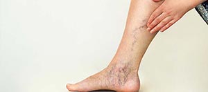 Varicose Veins (Phlebotomy) Treatment Specialist Near Me in Schaumburg, IL