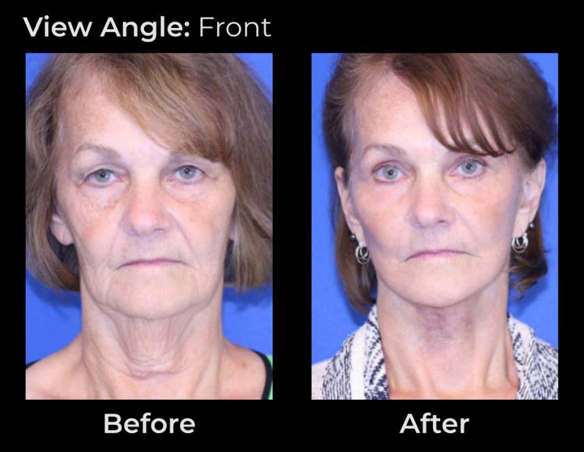 AwakeTight™ at Face Works Plastic Surgery, Plastic Surgeon Near Me in Schaumburg, AwakeTight™ at Face Works Plastic Surgery, Plastic Surgeon Near Me in Schaumburg,