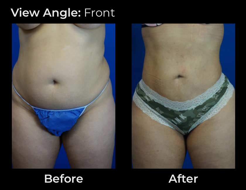 Liposuction at Face Works Plastic Surgery, Plastic Surgeon Near Me in Schaumburg, IL