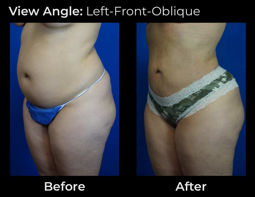 Liposuction at Face Works Plastic Surgery, Plastic Surgeon Near Me in Schaumburg, IL