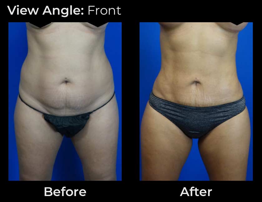 Liposuction at Face Works Plastic Surgery, Plastic Surgeon Near Me in Schaumburg, IL