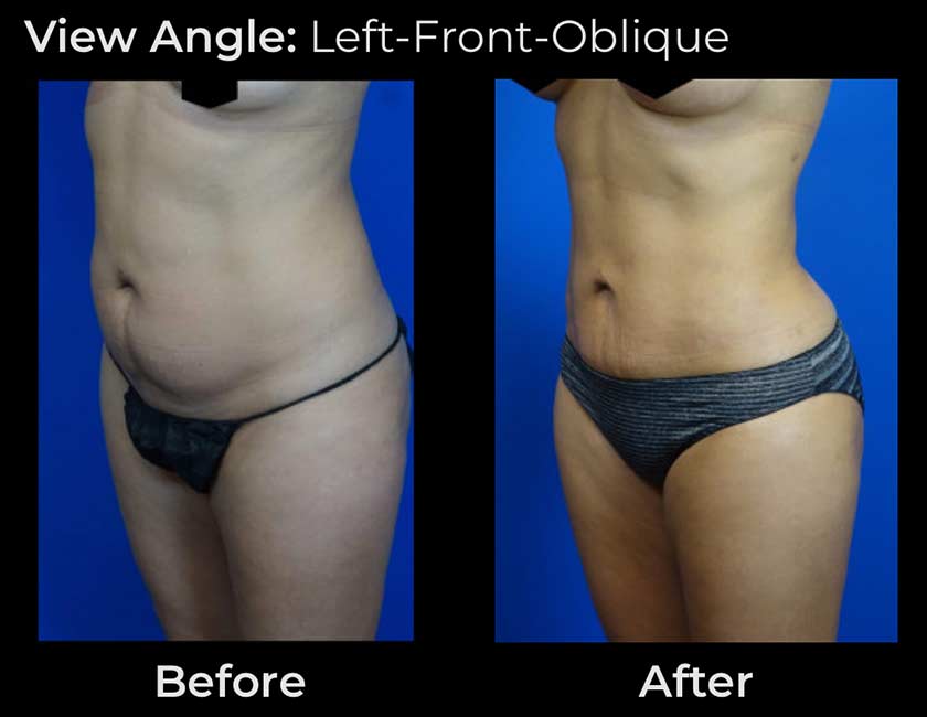 Liposuction at Face Works Plastic Surgery, Plastic Surgeon Near Me in Schaumburg, IL