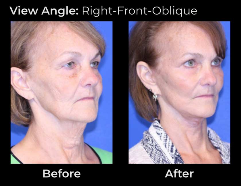 AwakeTight™ at Face Works Plastic Surgery, Plastic Surgeon Near Me in Schaumburg, AwakeTight™ at Face Works Plastic Surgery, Plastic Surgeon Near Me in Schaumburg,