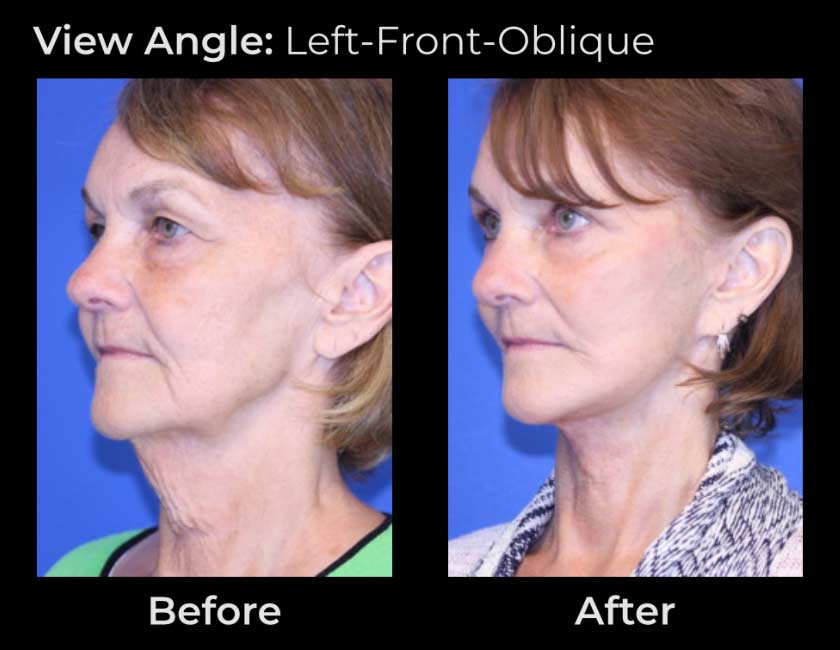 AwakeTight™ at Face Works Plastic Surgery, Plastic Surgeon Near Me in Schaumburg, AwakeTight™ at Face Works Plastic Surgery, Plastic Surgeon Near Me in Schaumburg,