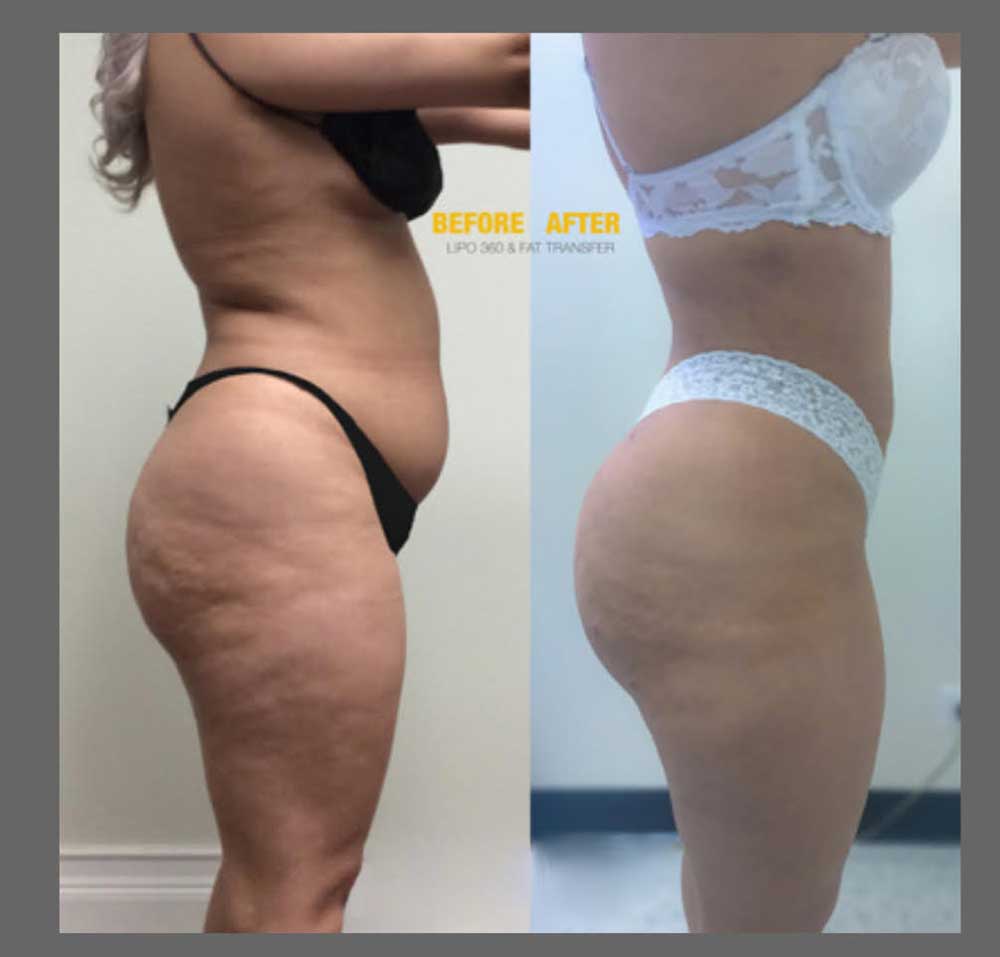 Brazilian Butt Lift (Fat Transfer or Liquid) Before & After Results at Face Works and Body Work Plastic Surgery