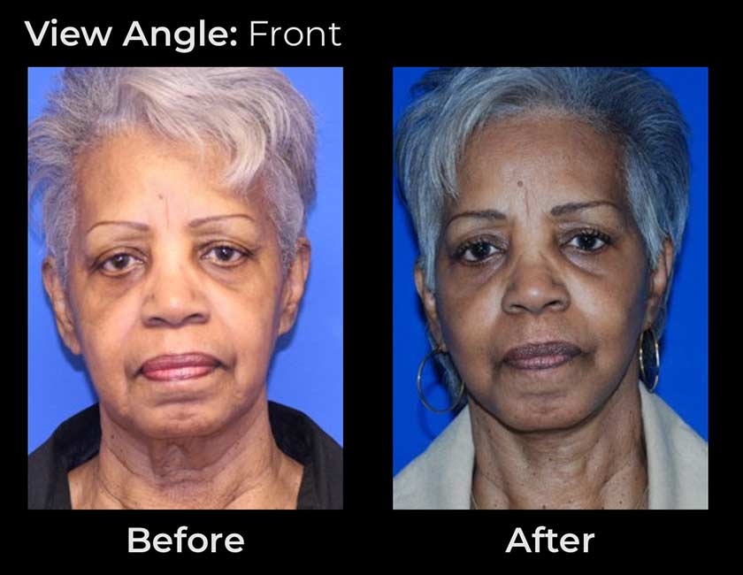 AwakeTight™ at Face Works Plastic Surgery, Plastic Surgeon Near Me in Schaumburg, AwakeTight™ at Face Works Plastic Surgery, Plastic Surgeon Near Me in Schaumburg,