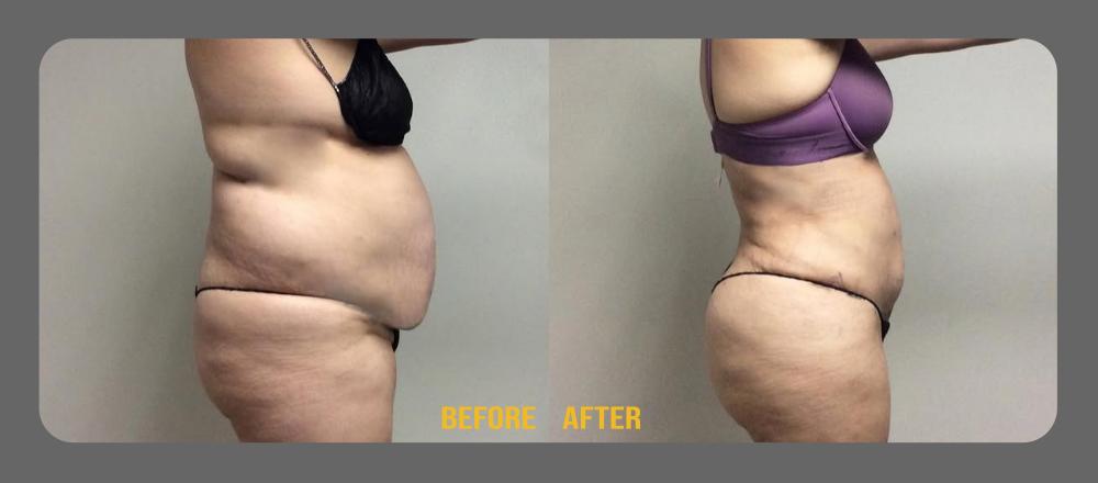 Tummy Tuck Before & After Treatment Results at Face Works and Body Works Plastic Surgery