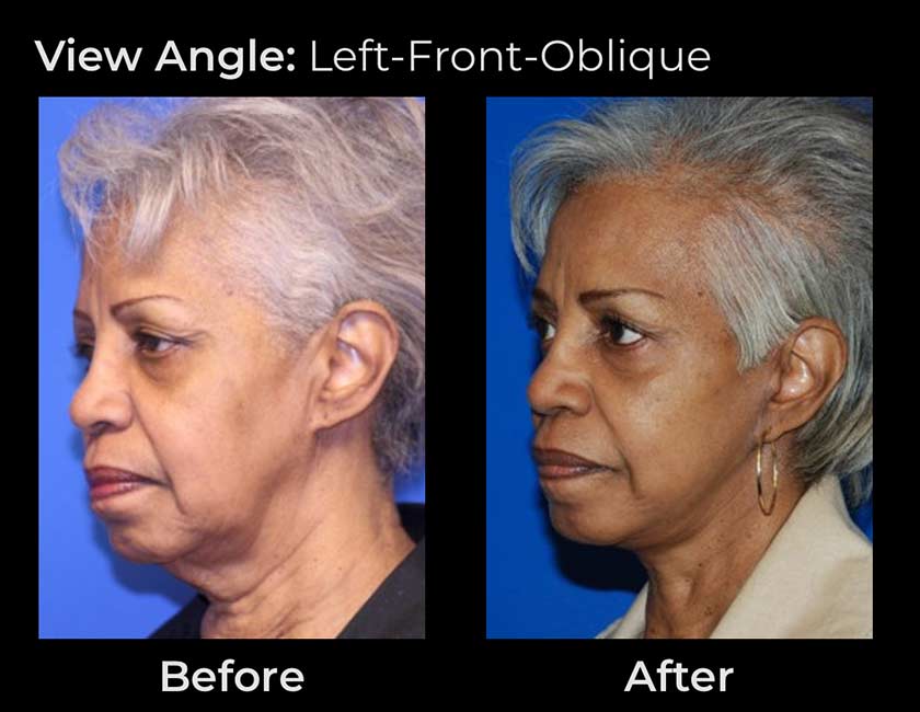 AwakeTight™ at Face Works Plastic Surgery, Plastic Surgeon Near Me in Schaumburg, AwakeTight™ at Face Works Plastic Surgery, Plastic Surgeon Near Me in Schaumburg,