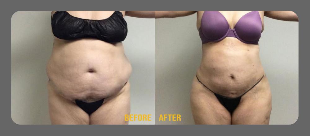 Tummy Tuck Before & After Treatment Results at Face Works and Body Works Plastic Surgery