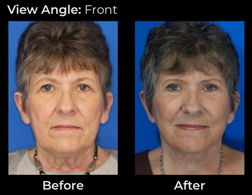 AwakeTight™ at Face Works Plastic Surgery, Plastic Surgeon Near Me in Schaumburg, AwakeTight™ at Face Works Plastic Surgery, Plastic Surgeon Near Me in Schaumburg,