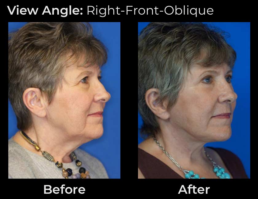 AwakeTight™ at Face Works Plastic Surgery, Plastic Surgeon Near Me in Schaumburg, AwakeTight™ at Face Works Plastic Surgery, Plastic Surgeon Near Me in Schaumburg,