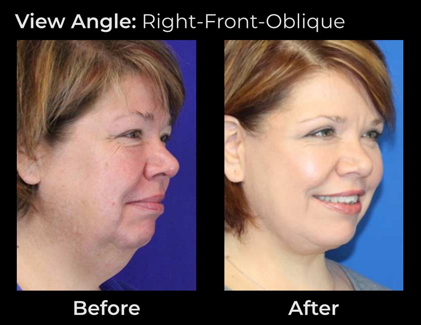 AwakeTight™ at Face Works Plastic Surgery, Plastic Surgeon Near Me in Schaumburg, AwakeTight™ at Face Works Plastic Surgery, Plastic Surgeon Near Me in Schaumburg,