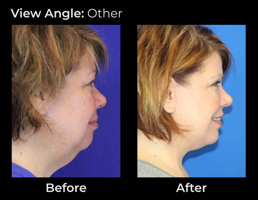 AwakeTight™ at Face Works Plastic Surgery, Plastic Surgeon Near Me in Schaumburg, AwakeTight™ at Face Works Plastic Surgery, Plastic Surgeon Near Me in Schaumburg,