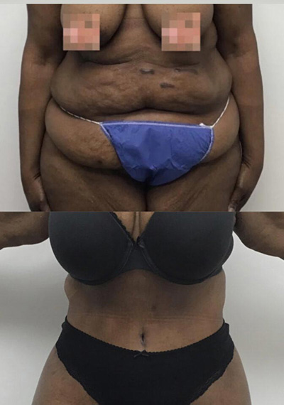 Tummy Tuck Before & After Treatment Results at Face Works and Body Works Plastic Surgery