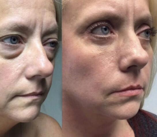 Eyelids Before & After Treatment Results at Face Works and Body Works Plastic Surgery