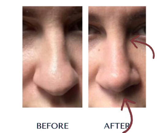 Nose Before & After Treatment Results at Face Works and Body Works Plastic Surgery