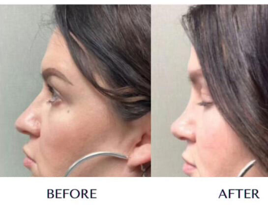 Nose Before & After Treatment Results at Face Works and Body Works Plastic Surgery