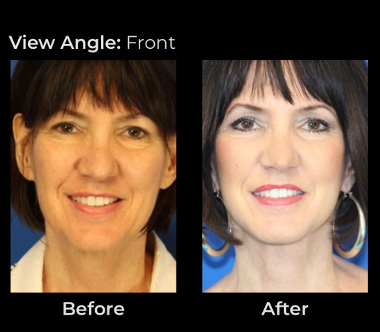 Eyelids Before & After Treatment Results at Face Works and Body Works Plastic Surgery