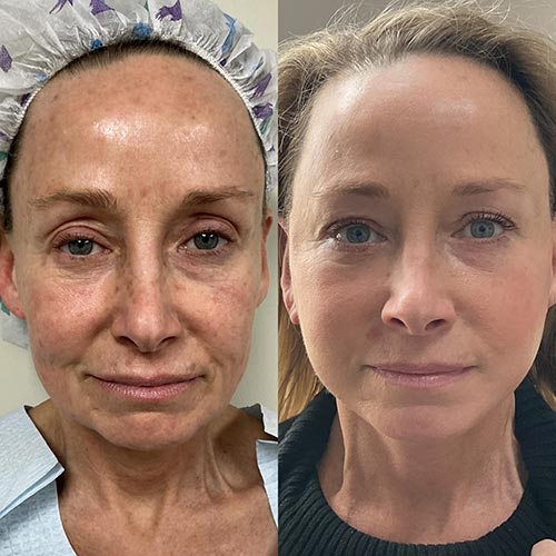 Face & Neck Lift Before & After Treatment Results at Face Works and Body Works Plastic Surgery