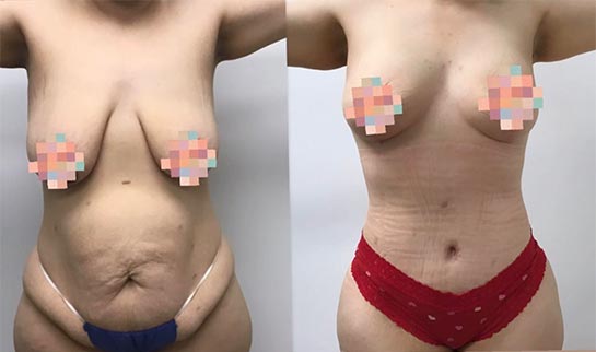 Breast Augmentation - Lift Before & After Results at Face Works and Body Work Plastic Surgery