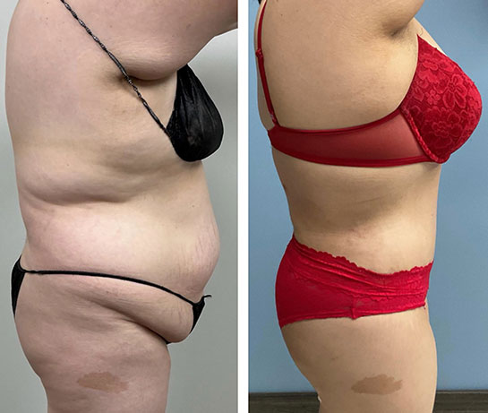 Mommy Makeover Before & After Treatment Results at Face Works and Body Works Plastic Surgery