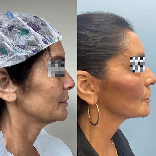 Face & Neck Lift Before & After Treatment Results at Face Works and Body Works Plastic Surgery