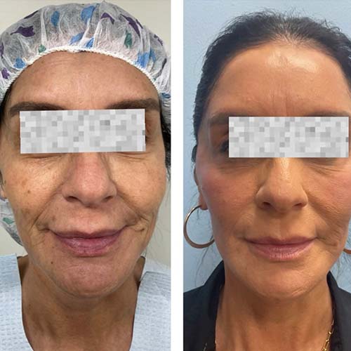 Face & Neck Lift Before & After Treatment Results at Face Works and Body Works Plastic Surgery