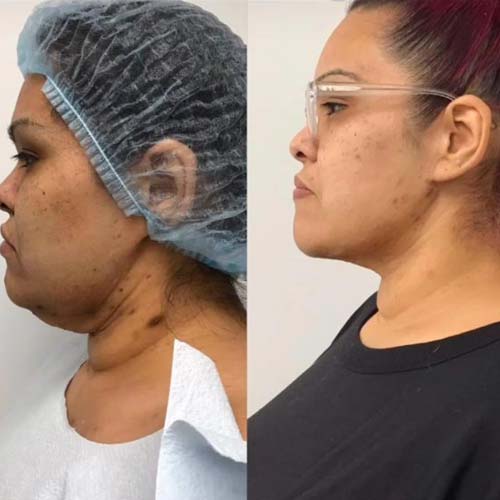 Face & Neck Lift Before & After Treatment Results at Face Works and Body Works Plastic Surgery