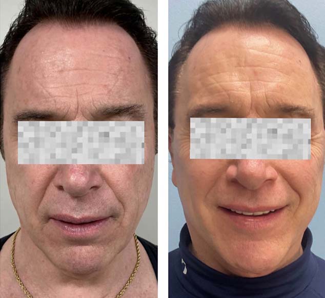 Face & Neck Lift Before & After Treatment Results at Face Works and Body Works Plastic Surgery