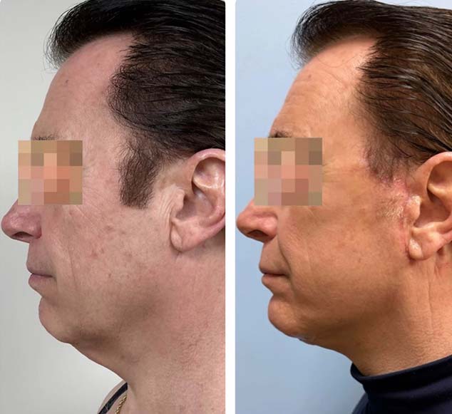 Face & Neck Lift Before & After Treatment Results at Face Works and Body Works Plastic Surgery