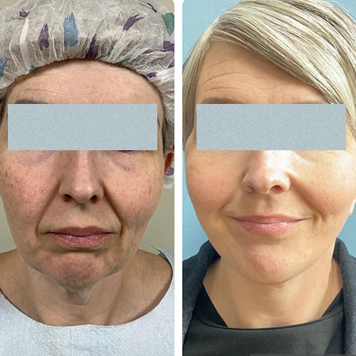 Face & Neck Lift Before & After Treatment Results at Face Works and Body Works Plastic Surgery