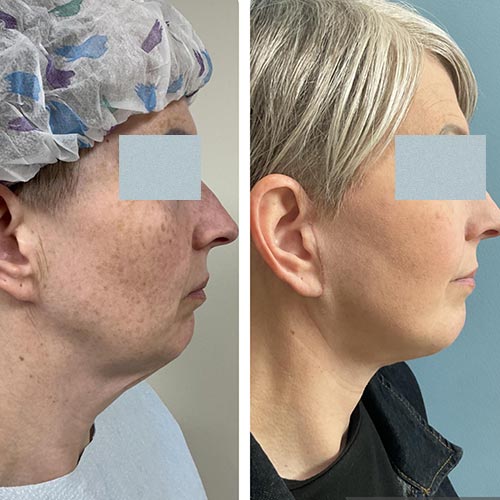 Face & Neck Lift Before & After Treatment Results at Face Works and Body Works Plastic Surgery