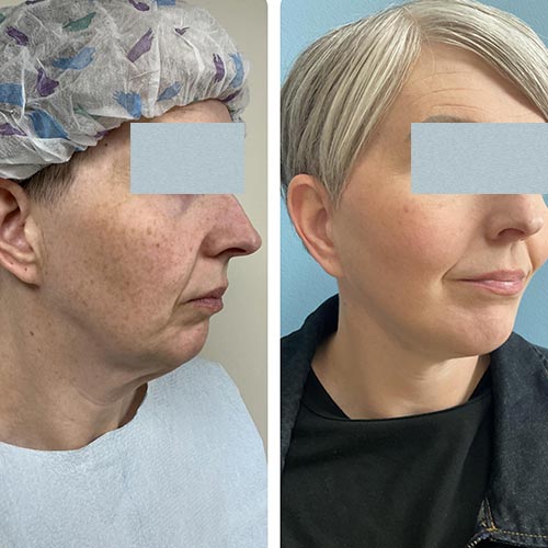Face & Neck Lift Before & After Treatment Results at Face Works and Body Works Plastic Surgery