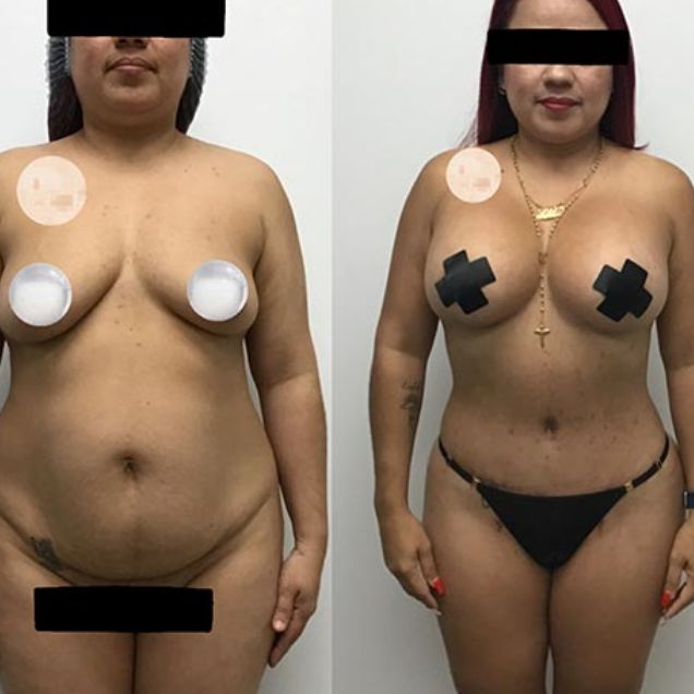 Before and After at Body Works Plastic Surgery, Plastic Surgeon in Chicago, IL Before and After at Body Works Plastic Surgery, Plastic Surgeon in Chicago, IL