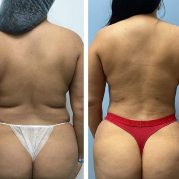 Before and After at Body Works Plastic Surgery, Plastic Surgeon in Chicago, IL Before and After at Body Works Plastic Surgery, Plastic Surgeon in Chicago, IL