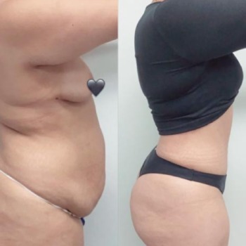 Before and After at Body Works Plastic Surgery, Plastic Surgeon in Chicago, IL Before and After at Body Works Plastic Surgery, Plastic Surgeon in Chicago, IL