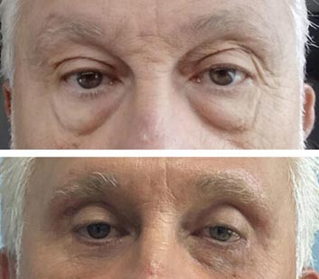 Eyelids Before & After Treatment Results at Face Works and Body Works Plastic Surgery