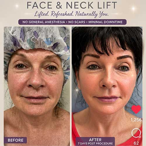 Face & Neck Lift Before & After Treatment Results at Face Works and Body Works Plastic Surgery
