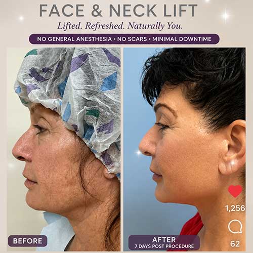 Face & Neck Lift Before & After Treatment Results at Face Works and Body Works Plastic Surgery