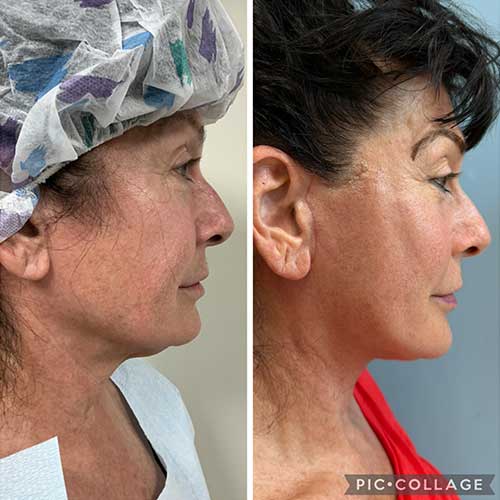 AwakeTight™ at Face Works Plastic Surgery, Plastic Surgeon Near Me in Schaumburg, AwakeTight™ at Face Works Plastic Surgery, Plastic Surgeon Near Me in Schaumburg,