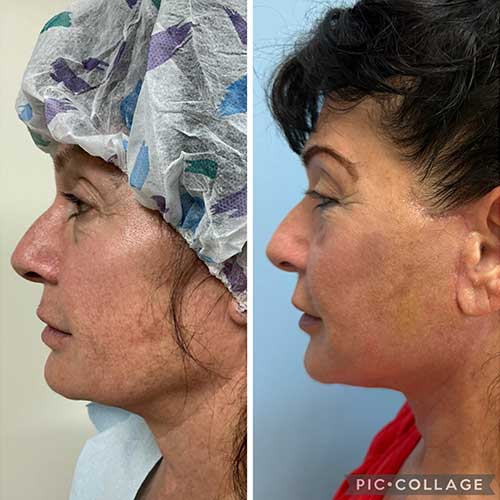 AwakeTight™ at Face Works Plastic Surgery, Plastic Surgeon Near Me in Schaumburg, AwakeTight™ at Face Works Plastic Surgery, Plastic Surgeon Near Me in Schaumburg,