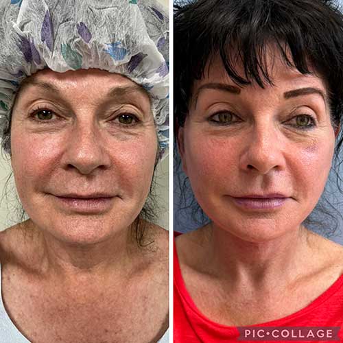 Face & Neck Lift Before & After Treatment Results at Face Works and Body Works Plastic Surgery