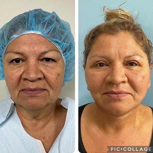 Face & Neck Lift Before & After Treatment Results at Face Works and Body Works Plastic Surgery