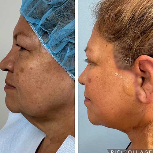 Face & Neck Lift Before & After Treatment Results at Face Works and Body Works Plastic Surgery