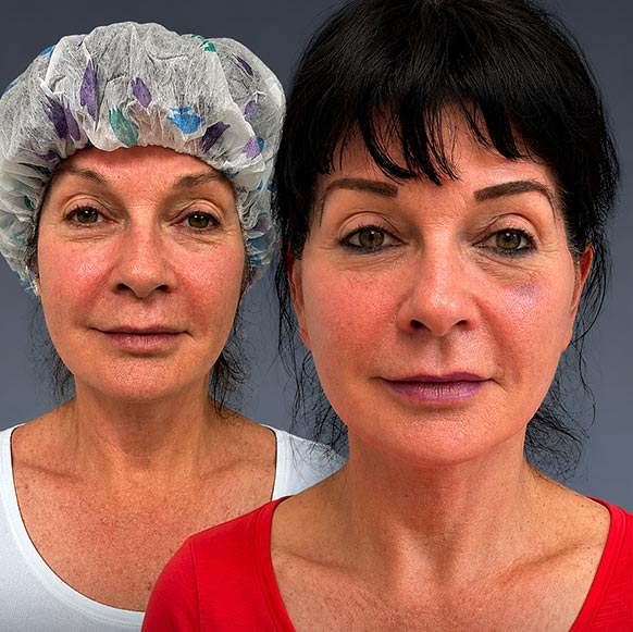 AwakeTight™ at Face Works Plastic Surgery, Plastic Surgeon Near Me in Schaumburg, AwakeTight™ at Face Works Plastic Surgery, Plastic Surgeon Near Me in Schaumburg,